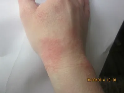 Красные пятна на руке, экзематозный дерматит фото - Вопрос дерматологу - 03  Онлайн