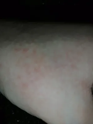 Аллергия на что-то? Красные пятнышки на руке Форум