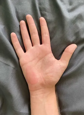Причины и лечение красных пятен на ладонях рук
