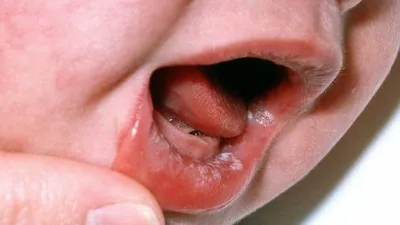 Белые пузырьки на языке у ребенка. Причины заболевания. Методы лечения |  Dental Art