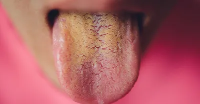 Желтый налет на языке у взрослых: признак какого заболевания, причины  возникновения, лечение болезни