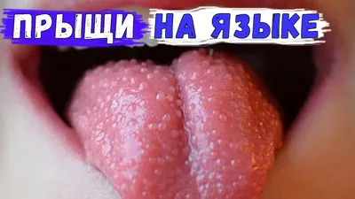 Почему появляются прыщики на языке?