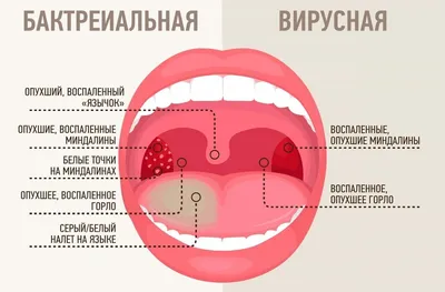 Стоматит у детей: виды, симптомы и лечение