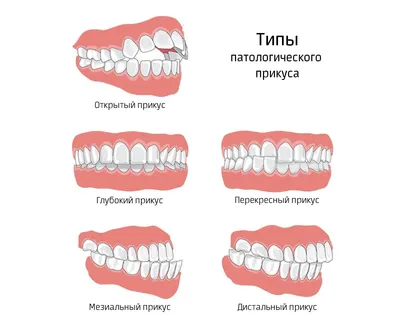 Неправильный прикус у пациента.