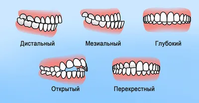 Неправильный прикус: виды, причины, методы исправления у детей и взрослых |  «Вита-Стом»