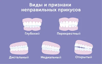 Влияние неправильного прикуса - Центр ортодонтии №1