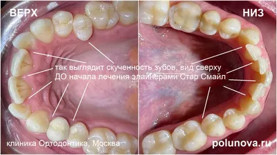 Неправильный прикус зубов: нижняя и верхняя челюсть