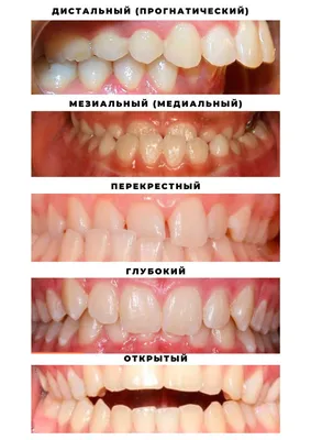 Исправление прикуса у взрослых и детей цена от 8 000 руб в Москве
