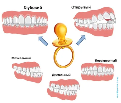 Неправильный прикус у ребенка — виды, причины, лечение в статье журнала  Startsmile