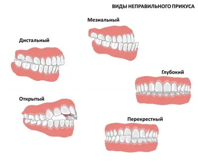 Нарушение прикуса: что такое, причины, виды