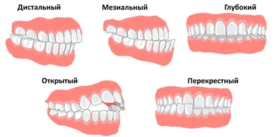 Как выбрать брекеты для исправления прикуса | НАВА