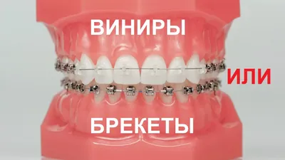 Раннее ортодонтическое лечение ребенка с расширением верхней челюсти