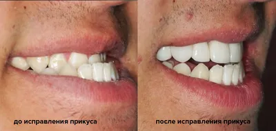 Коронки на зубах занизили прикус и разрушили другие зубы – клиника Smile  STD, Москва