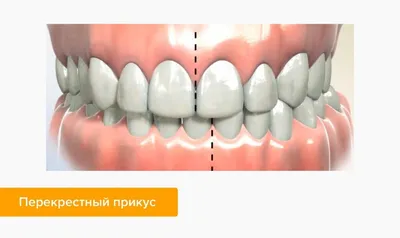 Реконструкция прикуса и зубов