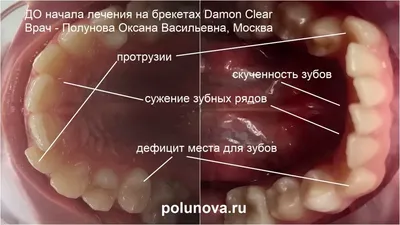 Коронки на зубах занизили прикус и разрушили другие зубы – клиника Smile  STD, Москва