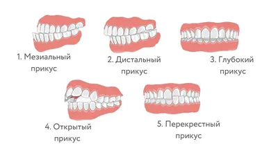 Перекрестный прикус: причины, симптомы, диагностика и методы лечения у  ортодонта для детей и взрослых