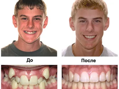 Влияние неправильного прикуса - Центр ортодонтии №1