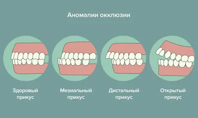 Как исправить неправильный прикус | Системы коррекции прикуса