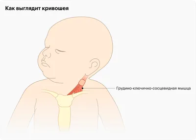 Кривошея у детей до года: признаки, симптомы, причины, лечение кривошеи у  новорожденных