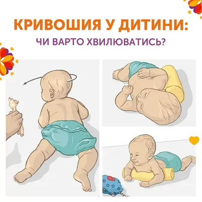 Кривошия у немовлят фото фотографии
