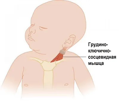 Кривошея у ребенка - признаки, причины, симптомы, лечение и профилактика -  iDoctor.kz