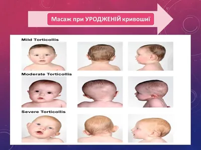 У новорожденных кривошею можно лечить путем развития пораженной мышцы. Для  этой цели используются: Специальный массаж Для консультации… | Instagram