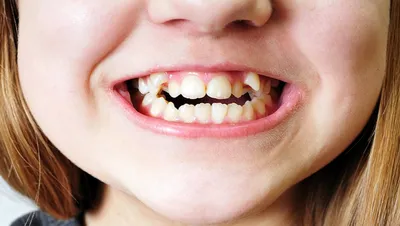 Кривые зубы у детей фото фотографии