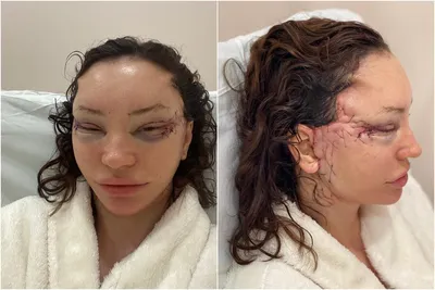 Круговая подтяжка лица фото сразу после операции фотографии
