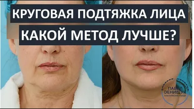 Подтяжка лица и шеи Запорожье | Львов | Днепр | Киев | Цена в клинике  Vidnova