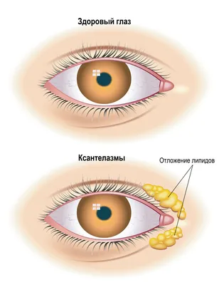 ◻️АКАДЕМИЯ КРАСОТЫ НАТАЛЬИ ЕГОРОВОЙ◻️ on Instagram: \"КСАНТОМЫ Ксантомы  образуются из-за отложения липидов в коже и других тканях. Это  желто-коричневые, оранжевые или розоватые пятна,папулы,бляшки (ксантелазмы),  узлы или инфильтраты.Ксантомы могут ...