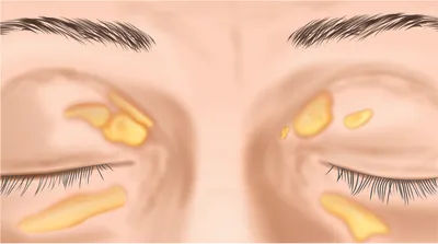 Ксантелазма: причины, симптомы и лечение