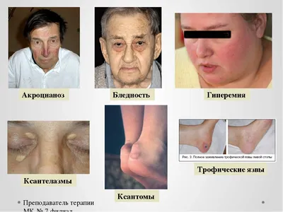Удаление ксантелазмы лазером в СПб | Лазерный Доктор