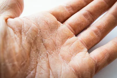 Сухость кожи рук: трещины, витамины, крем, мазь, лекарства, на пальцах.