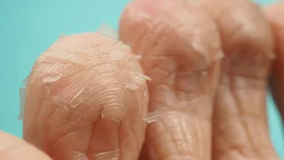 Как избавиться от шелушения кожи лица, головы, рук, кремы и мази от сухости  кожи
