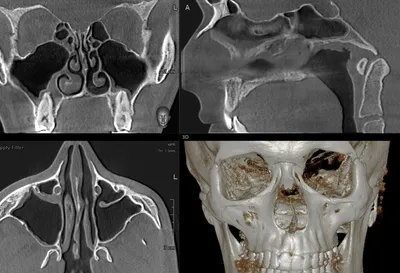КТ пазух носа, Компьютерная томография пазух | Компьютерная томография всех  ОНП, включая лобные и придаточных пазух носа