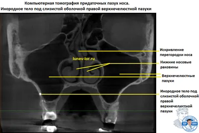 Диагностика гайморовых пазух носа при помощи КЛКТ (Конусно-лучевая  компьютерная томография в 3D проекции) » ЛОР клиника «ЛОР-Практика» в  Алматы: лечение заболеваний уха, горла, носа у детей и взрослых