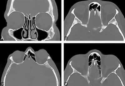 Что показывает компьютерная томография пазух носа, МРТ или КТ носовых и  околоносовых пазух?