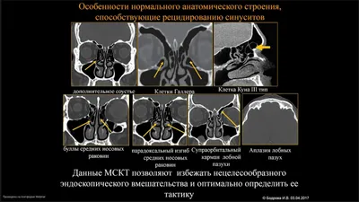 Пошаговый протокол описания анатомии околоносовых пазух перед  функциональной эндоскопической хирургией околоносовых пазух (FESS) по  данным конусно-лучевой компьютерной томографии