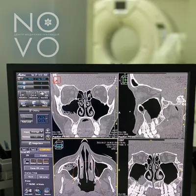 Что показывает КТ пазух носа | Медицинский центр \"Томограф\" | Дзен