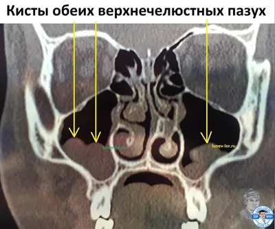 КТ носа и околоносовых пазух — цены в Москве | Клиника Семейный доктор