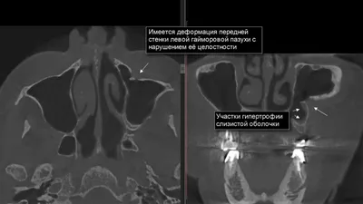 Расшифровка КТ пазух носа | Второе мнение