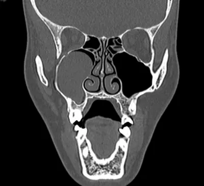 КТ носа и пазух - что такое, что покажет процедура, подготовка, расшифровка