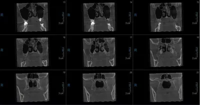 КТ пазух носа в Екатеринбурге - цены на КТ придаточных пазух носа в Новой  Больнице