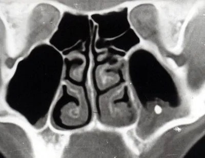 Компьютерная томогорафия придаточных пазух носа - фото - ЛОР в Самаре -  врач Лунёв Андрей Владимирович