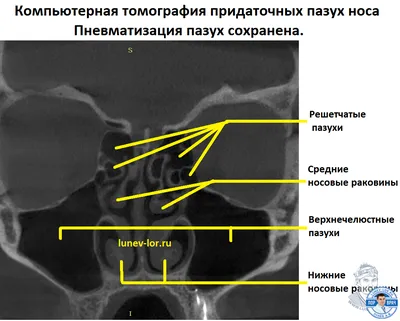 Компьютерная томогорафия придаточных пазух носа - фото - ЛОР в Самаре -  врач Лунёв Андрей Владимирович