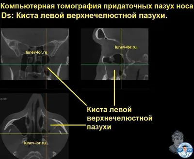 Инородное тело гайморовой пазухи Заболевания