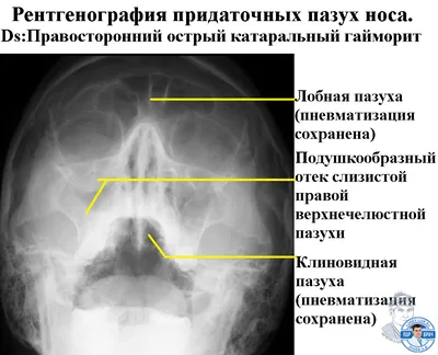 Tomogram - КТ придаточных пазух носа в диагностическом... | Facebook