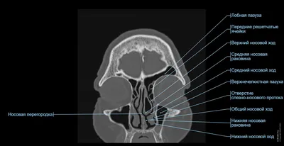 Компьютерная томография околоносовых пазух - КТ пазух носа, КТ придаточных пазух  носа в Нижнем Новгороде | ТОНУС ПРЕМИУМ