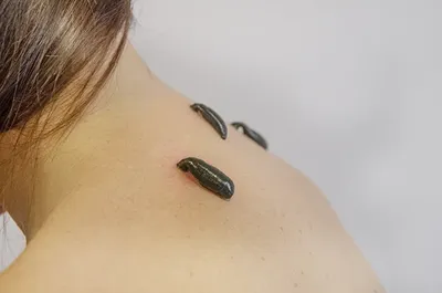 Куда ставить пиявки на лицо для омоложения фото — Куда и как ставить пиявки  на лицо от морщин? | Как убрать морщины на лице