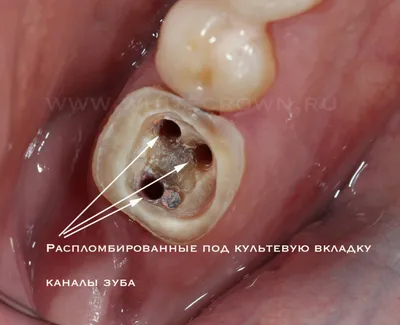 Зубная культевая вкладка - что это, виды, плюсы и минусы